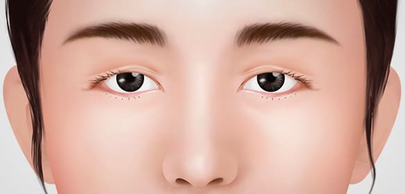 目の手術 - アンチエイジング(anti aging)
