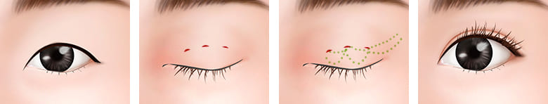 目の手術 - 二重(eye)